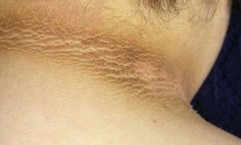 ঘাড় ও গলা কালো হয়ে যাওয়ার পাঁচ কারণ, জেনে নিন সমাধান